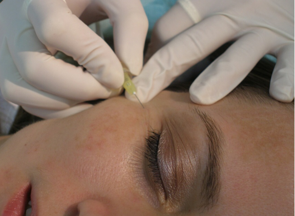 Karboxyterapie (Dermaesthetic, MUDr. Hana Šulcová, MBA)